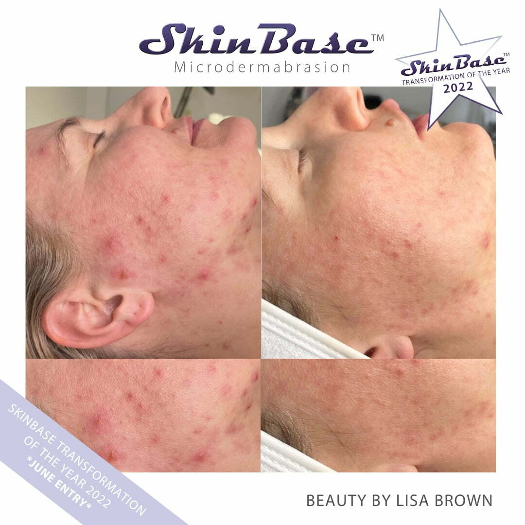 microdermabrasion results acne before and after
