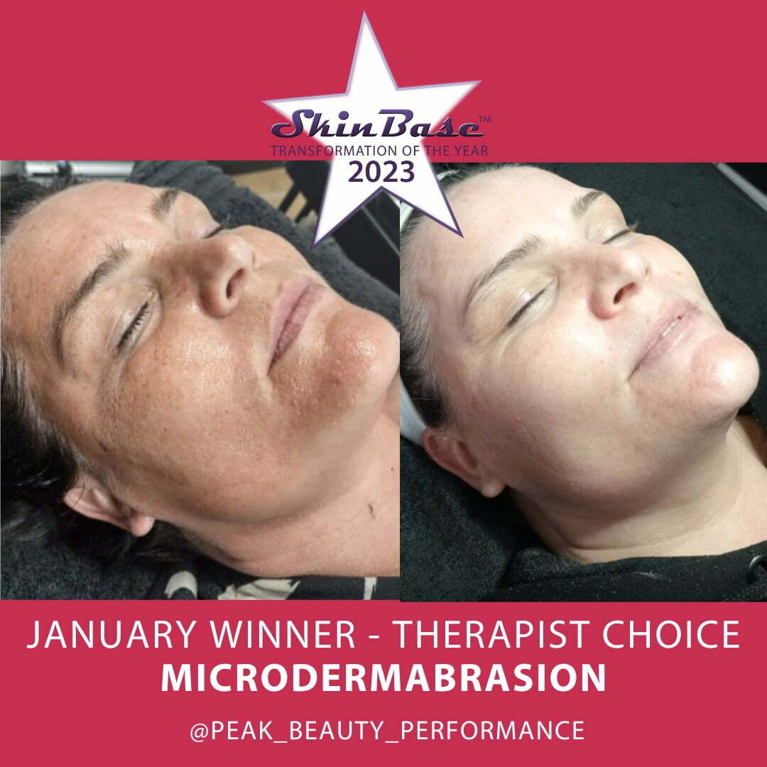 Microdermabrasion before and after results