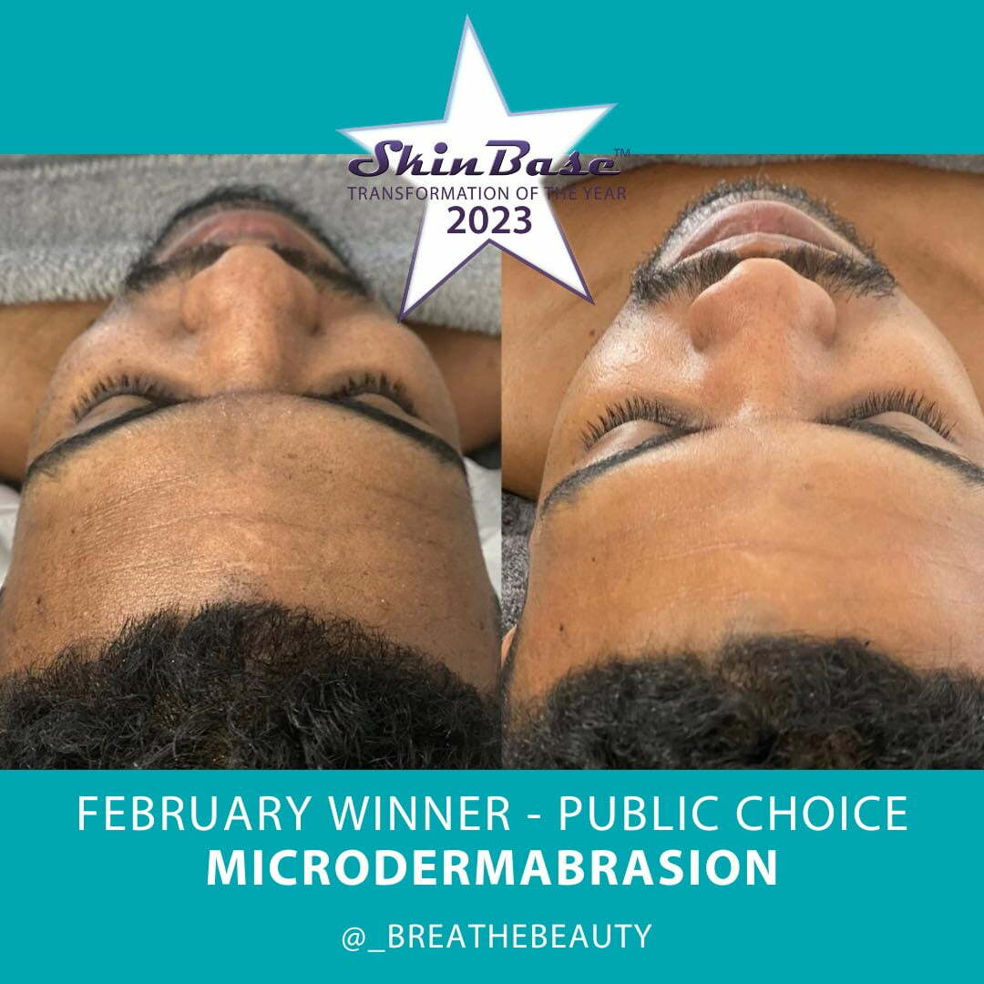 male microdermabrasion transformation dry skin