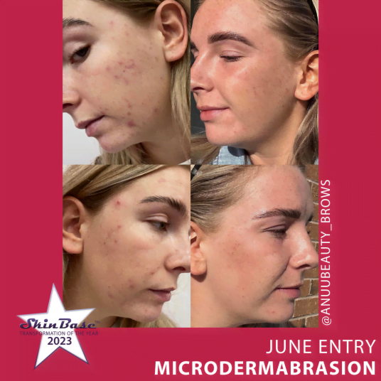 ANUUBEAUTY MICRODERMABRASION RESULTS