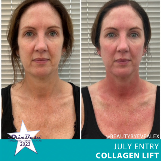 Collagen Lift July Entries