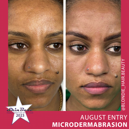 microdermabrasion august before and afters