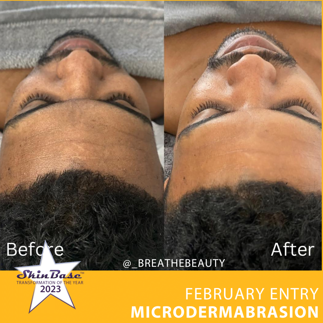 Microdermabrasion before and after