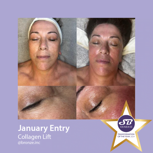 January collagen lift entries