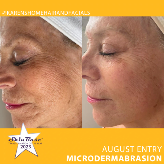 august microdermabrasion before and afters
