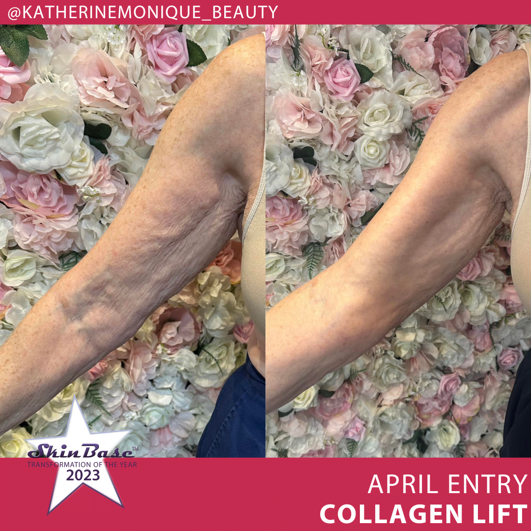 April transformation entries skin laxity on arms