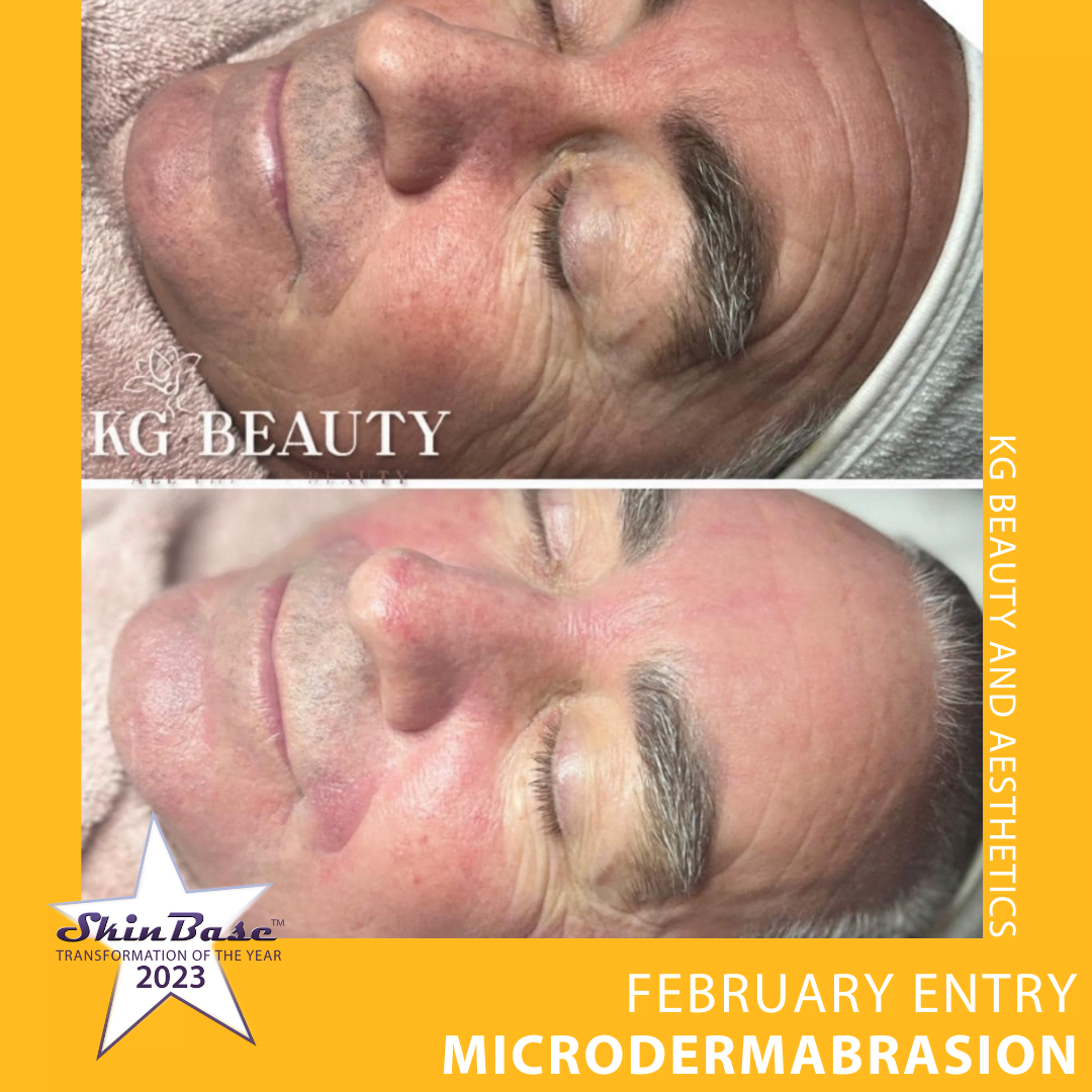 Microdermabrasion before and after