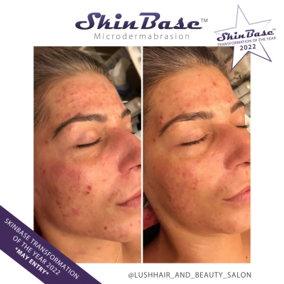 microdermabrasion acne before and after