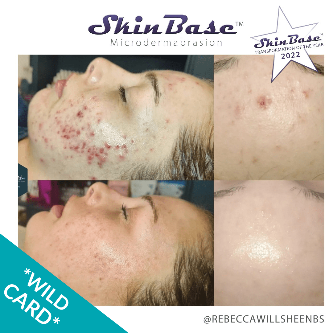 Microdermabrasion for acne treatment