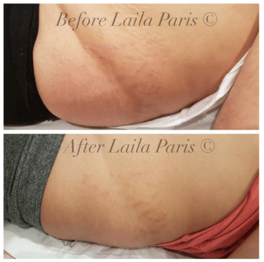stretch marks - how skinbase microdermabrasion can help