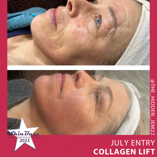Collagen Lift July Entries