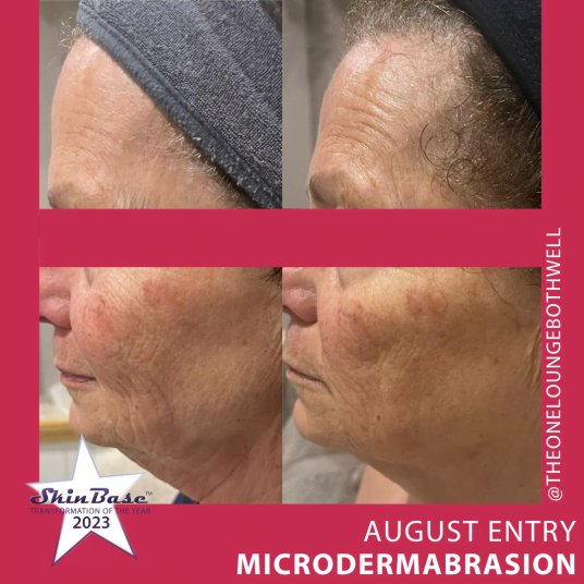 August Microdermabrasion Before and Afters